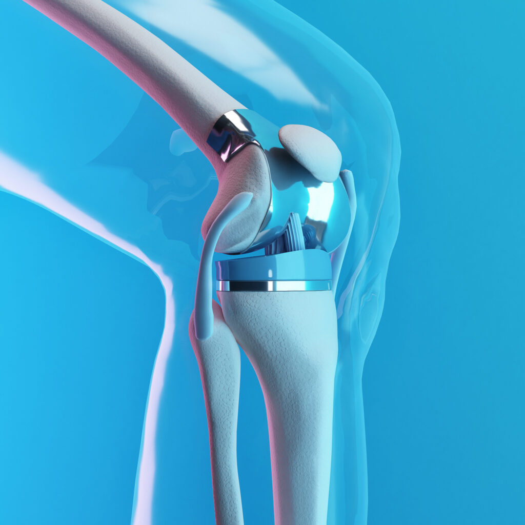 Knee Replacement